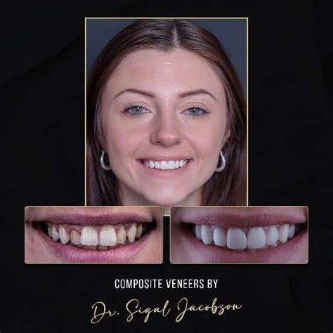 composite veneers cost melbourne.